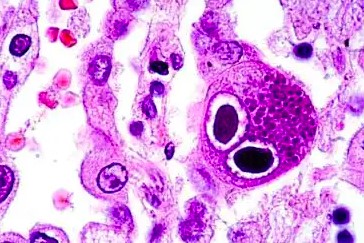 Mengenal Cytomegalovirus (CMV), Bahaya Tersembunyi di Balik Kesehatan Anda